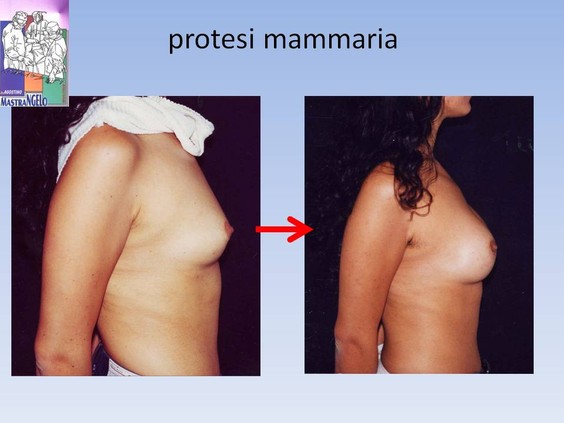 protesi-mammaria-2_nu67xtv1