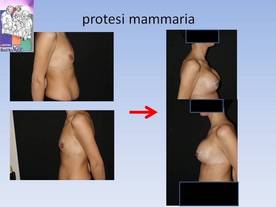 protesi-mammaria-3_2eq7ugdc
