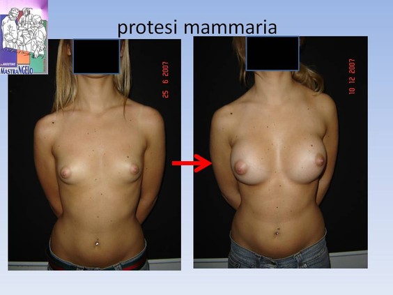 protesi-mammaria-4_p37i3z94