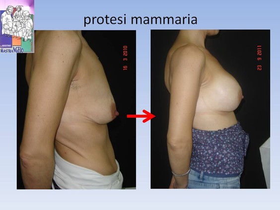 protesi-mammaria-5_38s32l24