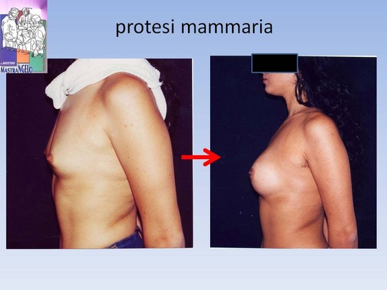 protesi-mammaria_zfs3195m