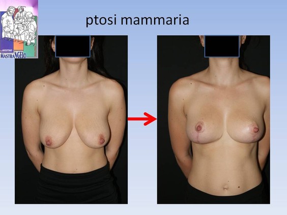 ptosi-mammaria-2_c8u951s8