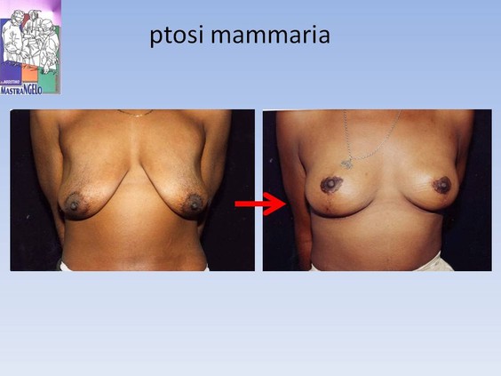 ptosi-mammaria-3_mbxl08nf